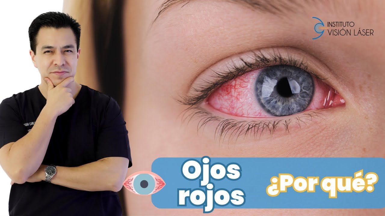 Ojo rojo